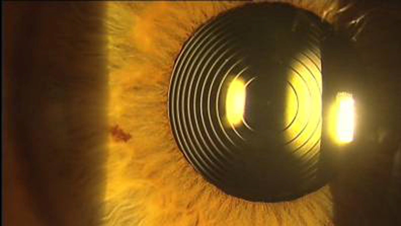 Exemplo ilustrativo de lente intraocular